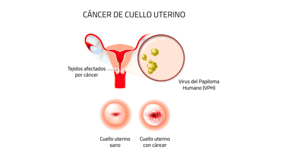 Productos VPH alto riesgo