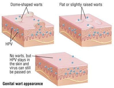 Verrugas VPH