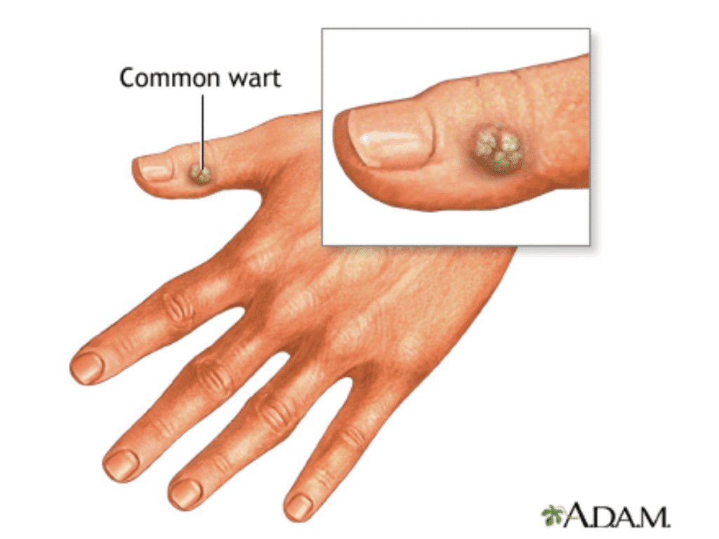 Verruga común