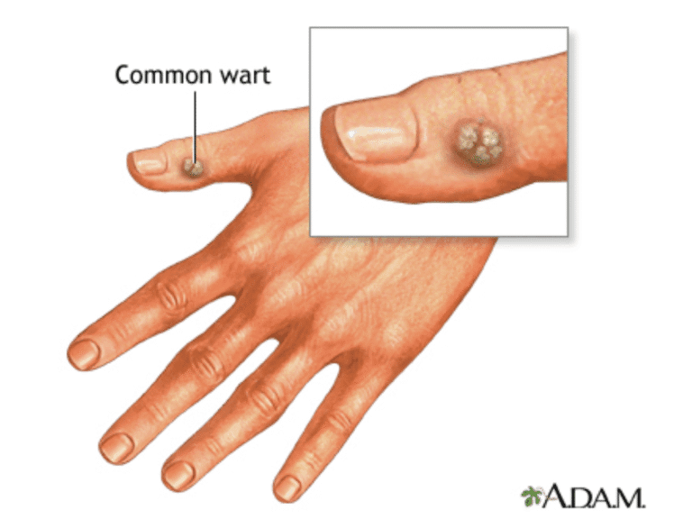 Verruga común