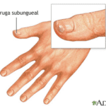 Verrugas ungueales