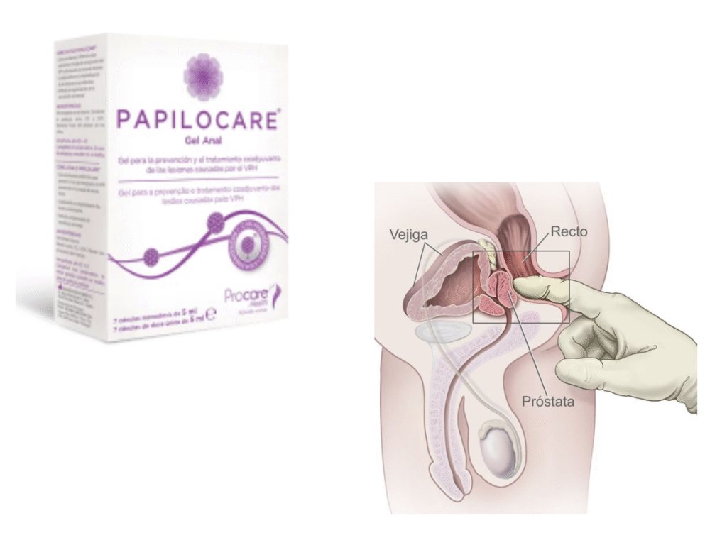 Gel anal ayuda VPH