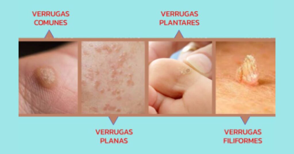 Tipos de verrugas