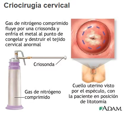 Crioterapia
