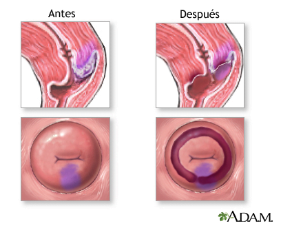 LEEP antes y después