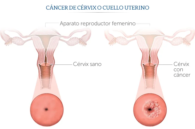 Cérvix sano y con cáncer