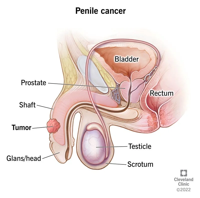 Cáncer de pene