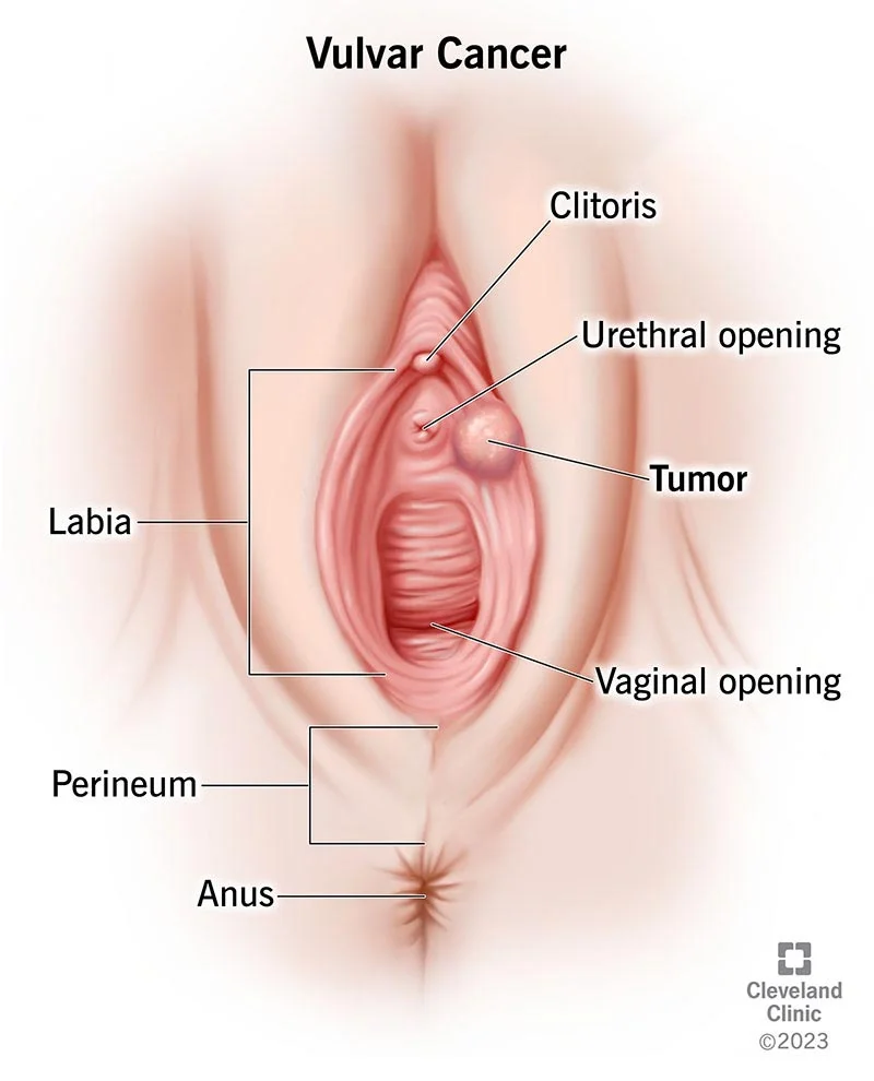 Cáncer de vulva