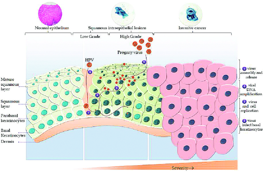 Fases cáncer cervical