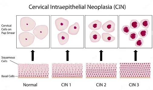 CIN3 HSIL diplasia cervucak severa