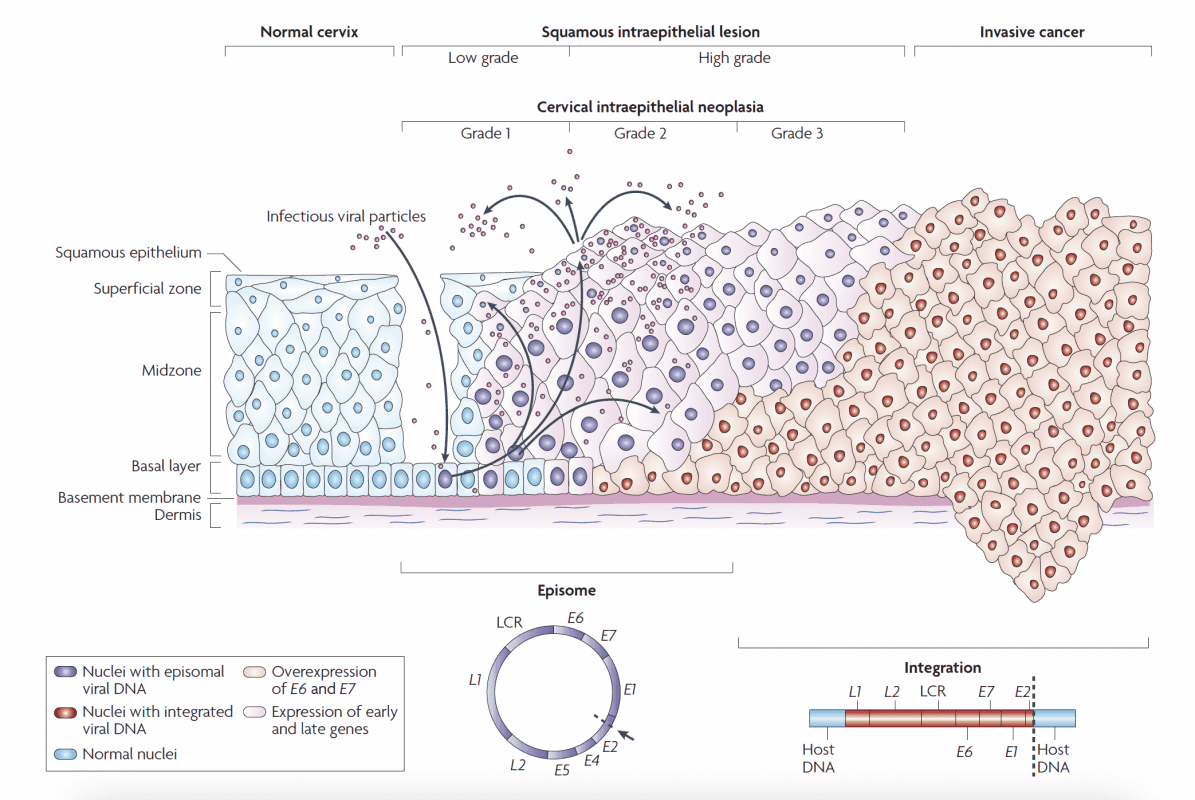 AIS adenocarcinoma in situ