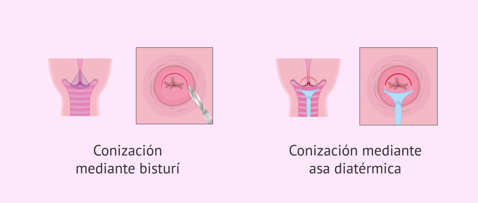 Conización VPH