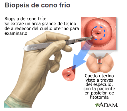 Bisturí frío