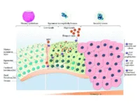 Adenocarcinoma In Situ