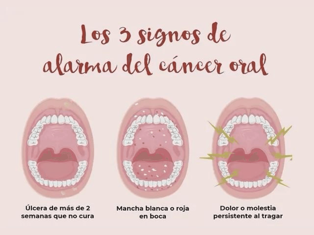 Cáncer oral signos