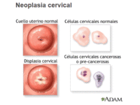 Neoplasia cervical