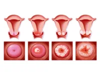 Fases desarrollo cáncer cervical