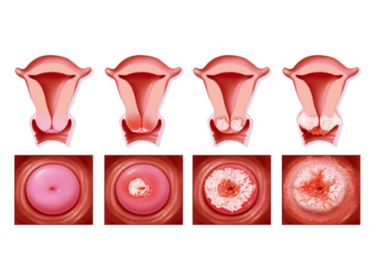 Fases desarrollo cáncer cervical
