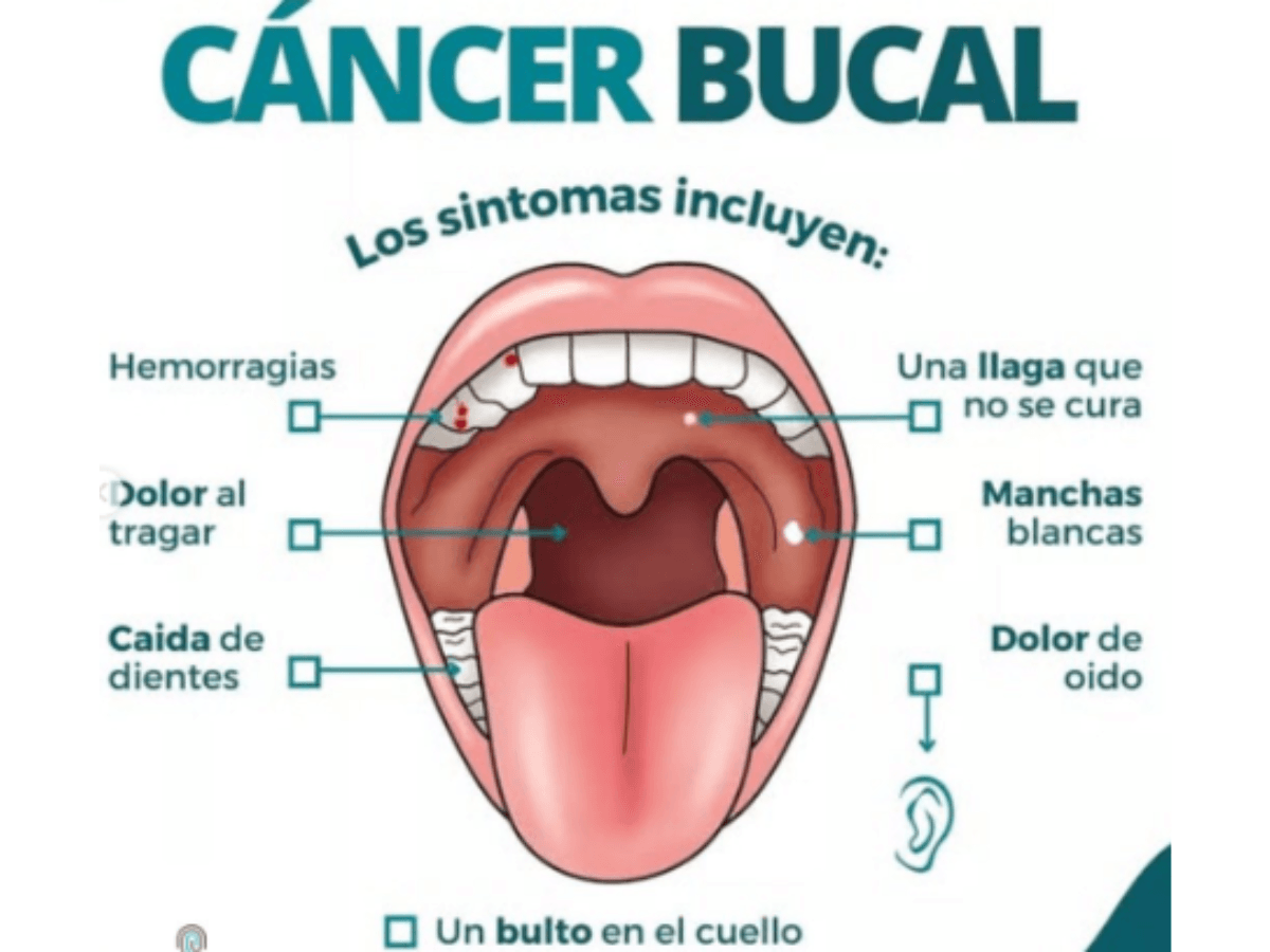 Síntomas cáncer bucal
