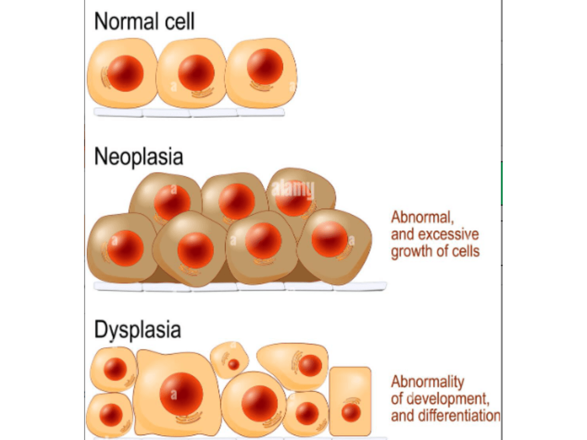 Sistema CIN3 HSIL: neoplasia y displasia