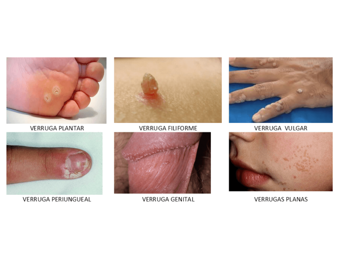 Tipo de verrugas
