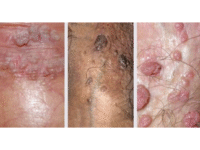 Foto 3 verrugas genitales