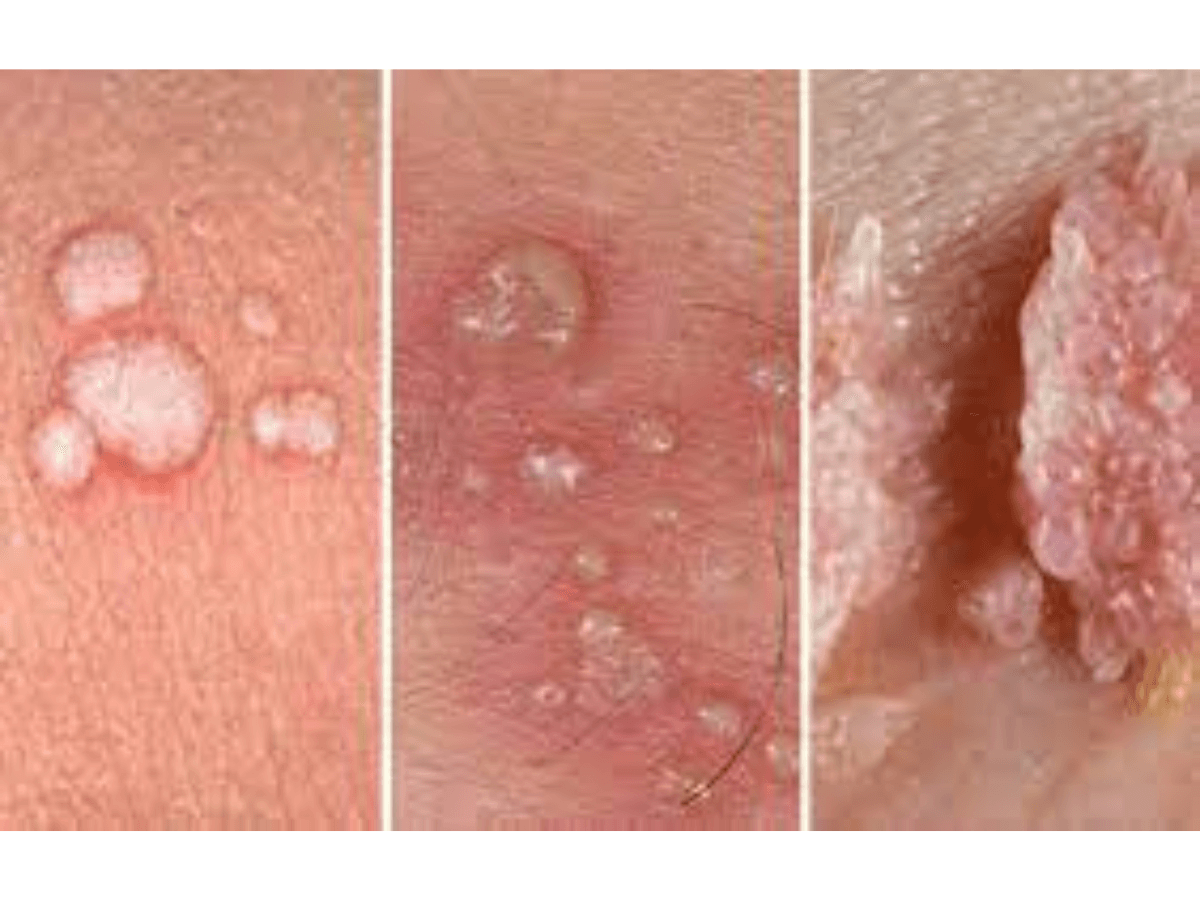 Foto 1 verrugas genitales
