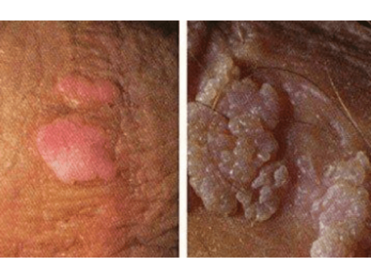 Foto 2 verrugas genitales