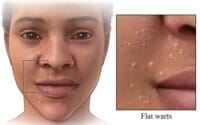 Verrugas planas