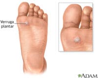 Verrugas plantares