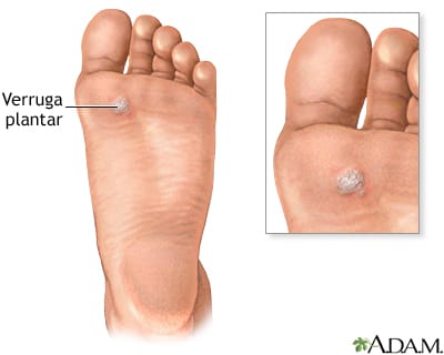 Verrugas plantares