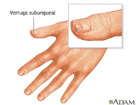 Verrugas ungueales