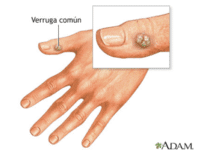 Verrugs comunes