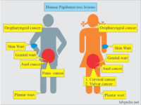 Virus papilioma humano