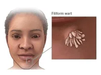 Verrugas filiformes
