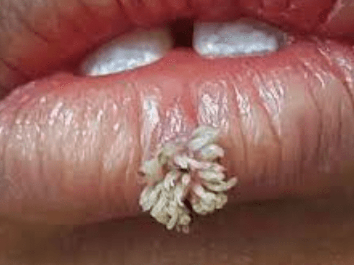 Verruga filiforme en labio