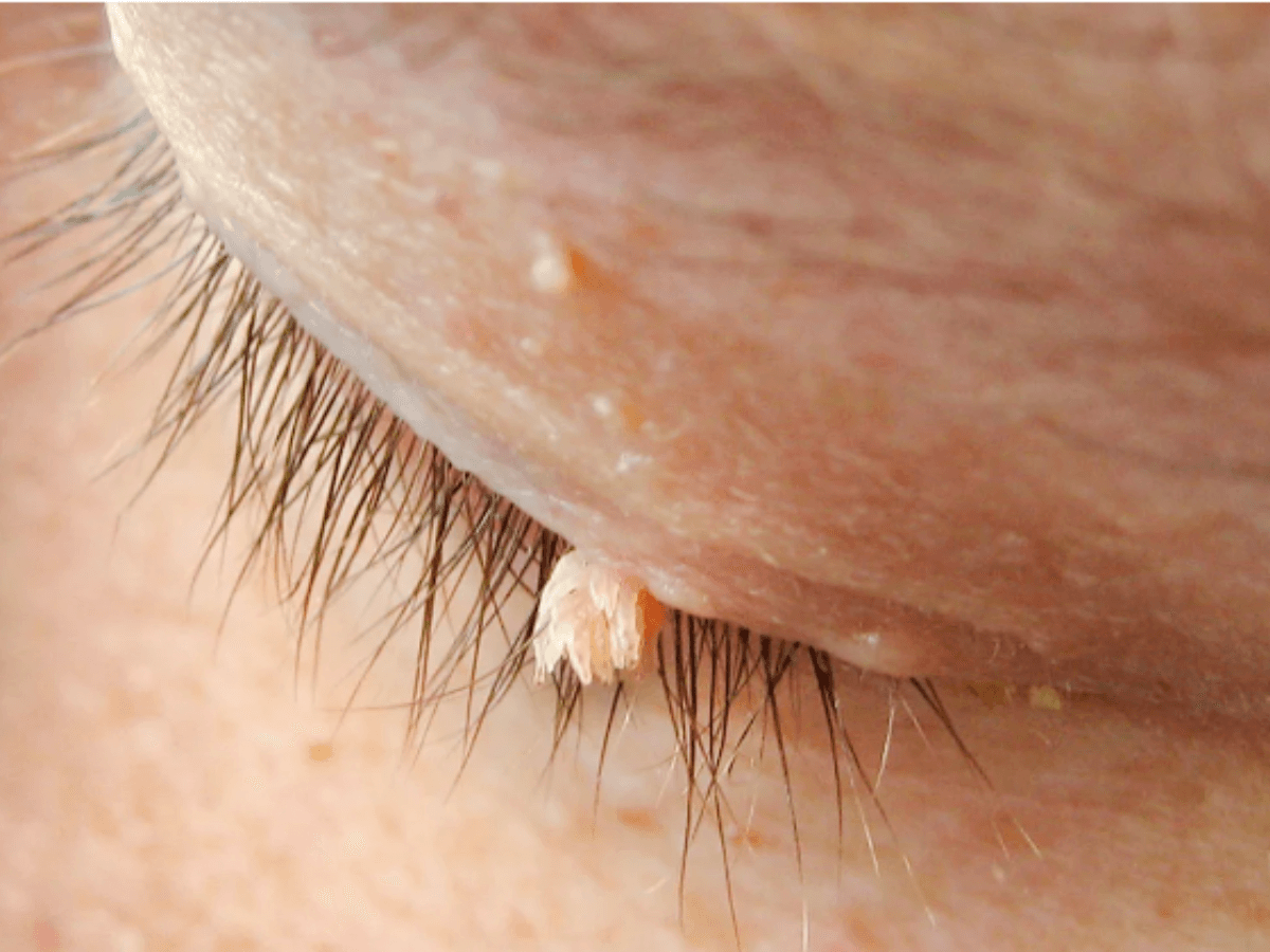 Verruga filiforme en párpado