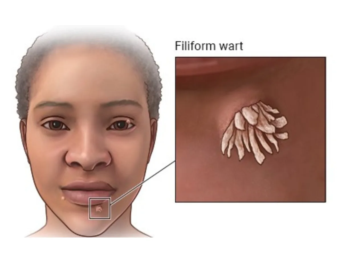 Verrugas filiformes