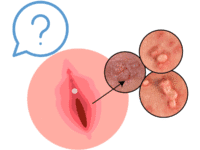 Preguntas verrugas genitales