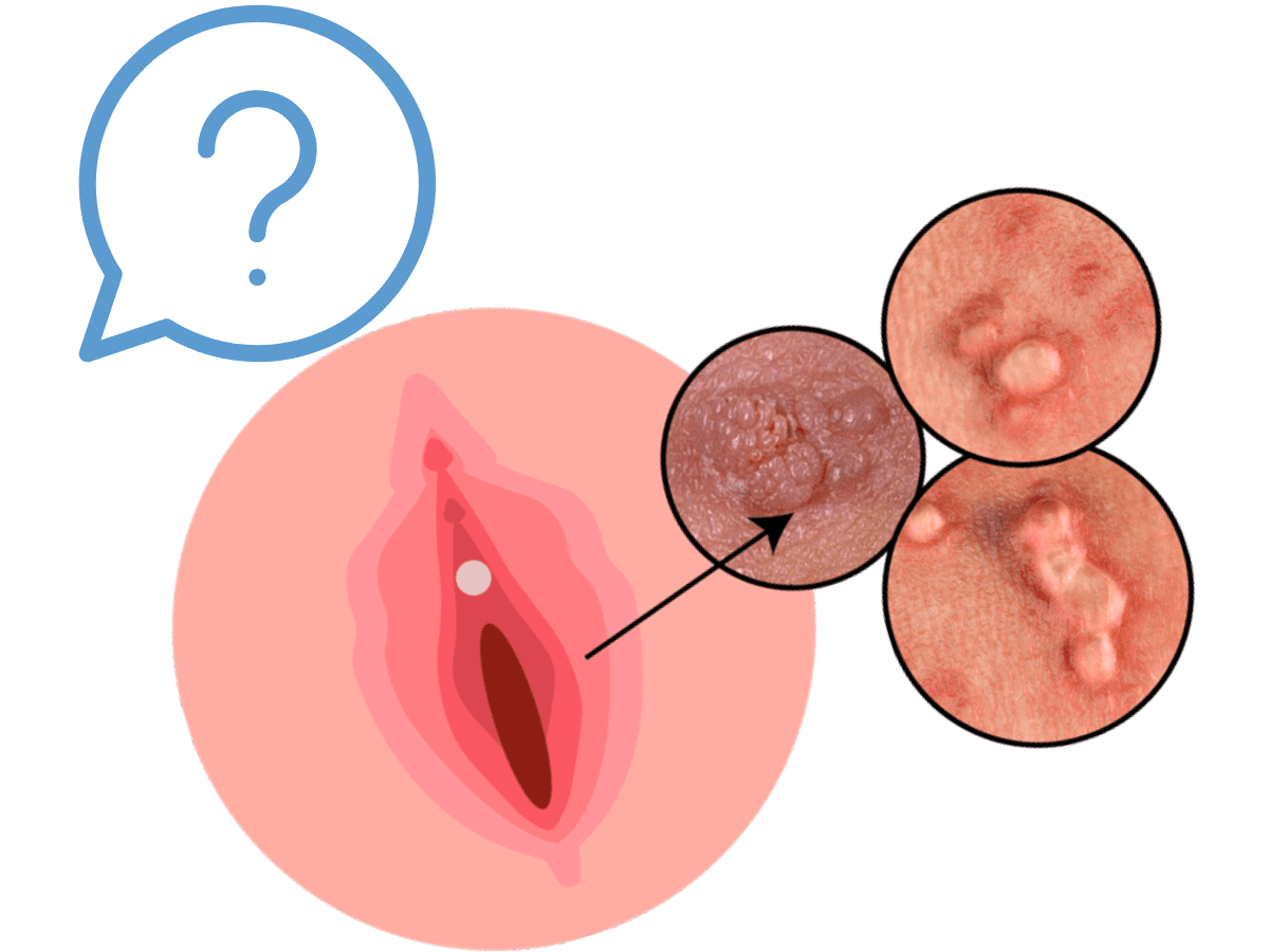 Preguntas verrugas genitales