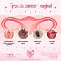 cáncer vaginal