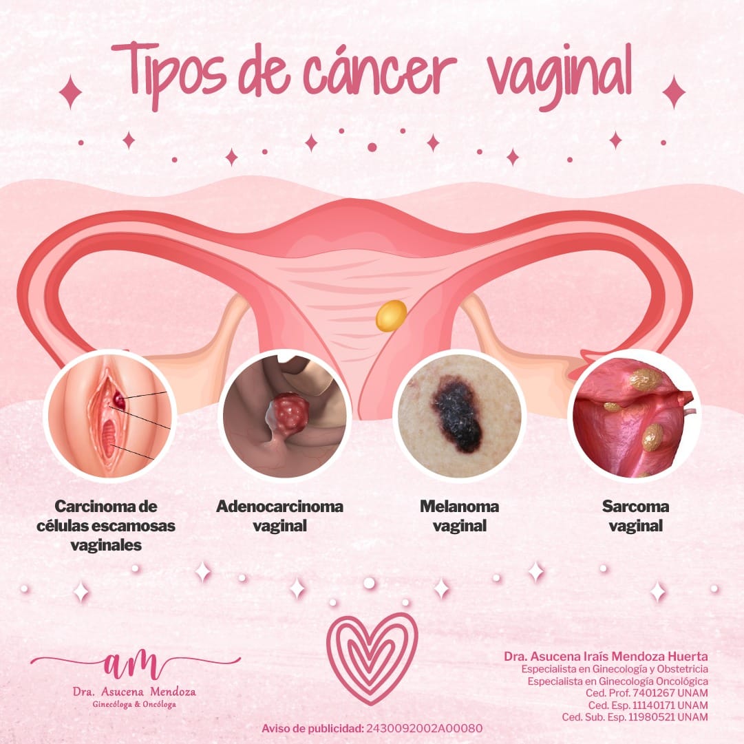 cáncer vaginal