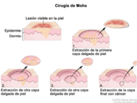 cirugía de Mohs