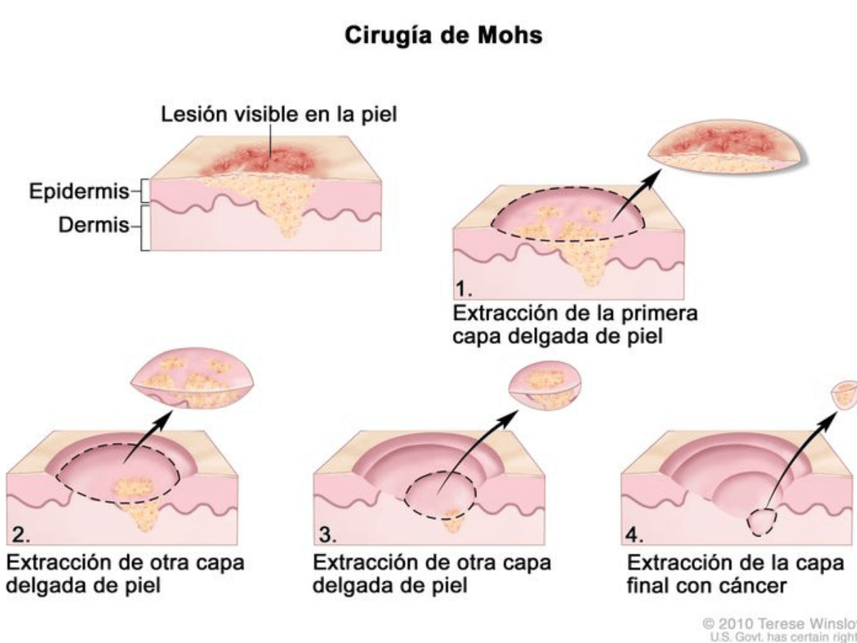 cirugía de Mohs