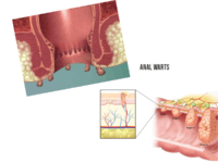 Verrugas anales