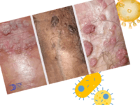 verrugas genitales pene